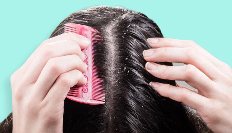 تفاوت شوره سر و خشکی پوست سر