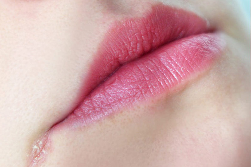 خشکی دور لب