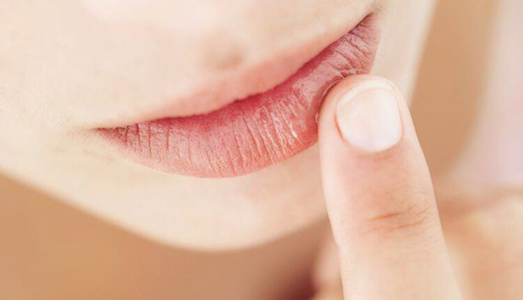 خشکی دور لب