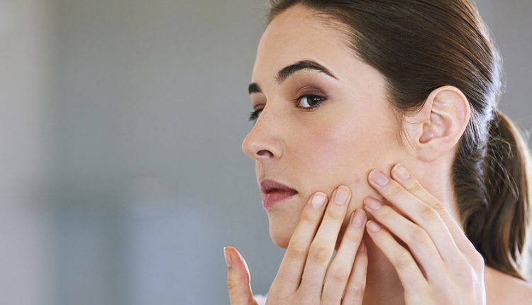 درمان پوست چرب و جوش دار