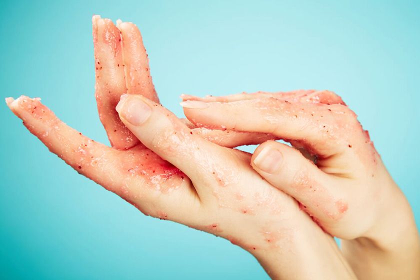 درباره لایه برداری پوست