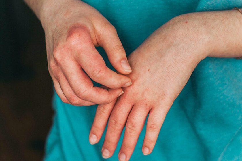 علت خشکی پوست