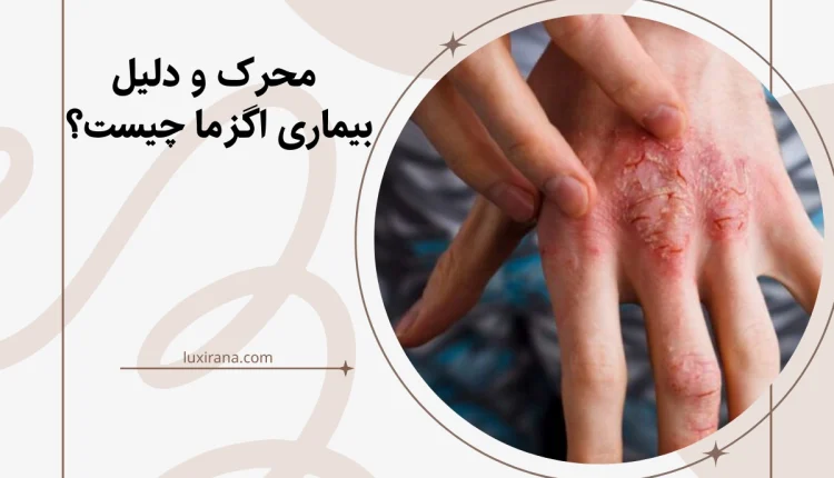 محرک و دلیل بیماری اگزما چیست؟