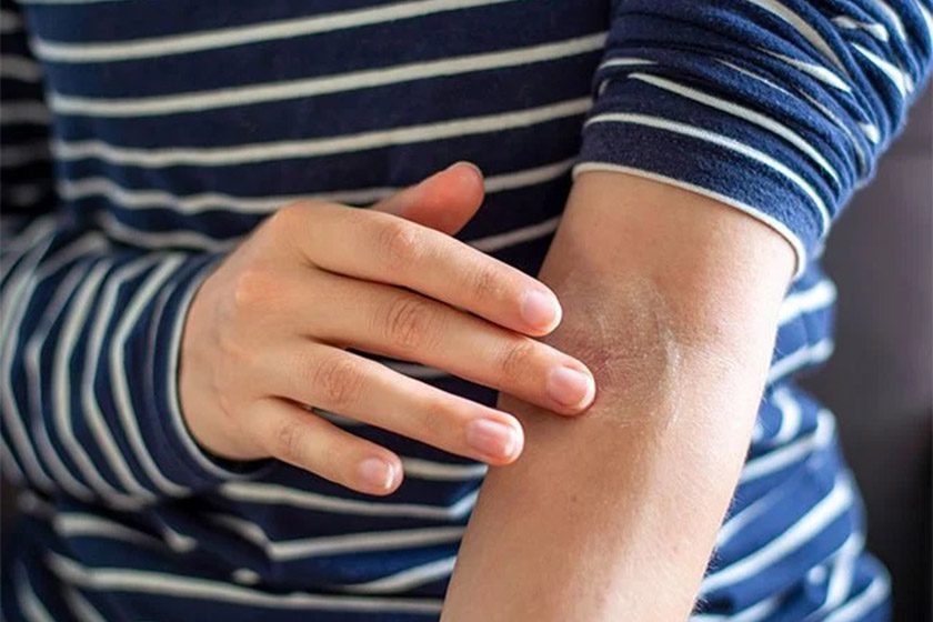 انواع خشکی پوست