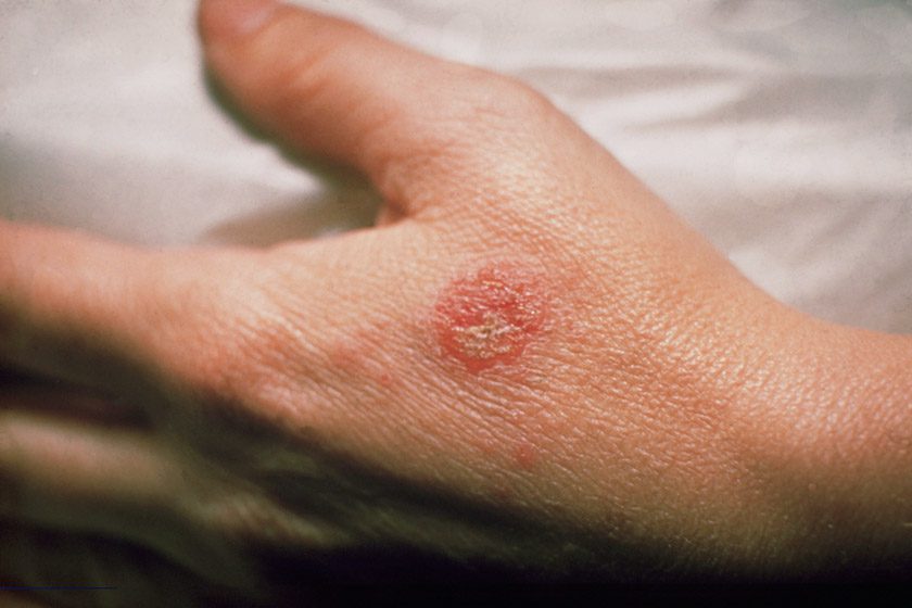 دلیل بیماری اگزما