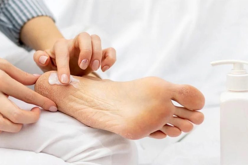 درمان خشکی پوست پا
