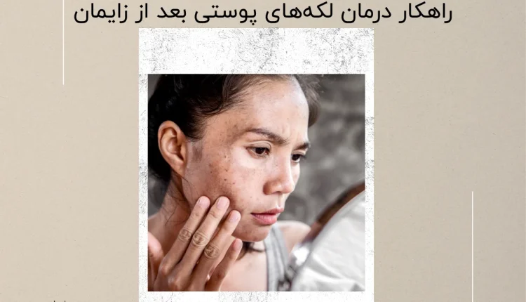 درمان لکه‌های پوستی بعد از زایمان