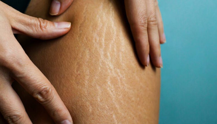 جلوگیری از ترک‌های پوستی