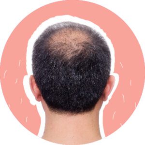 تشخیص موهای آسیب دیده