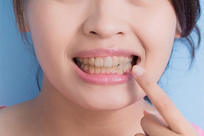 دهان شویه برای از بین بردن جرم دندان