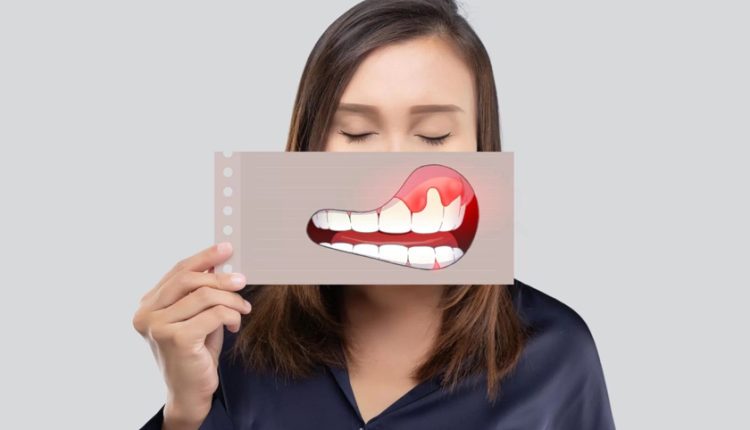 درمان تورم لثه