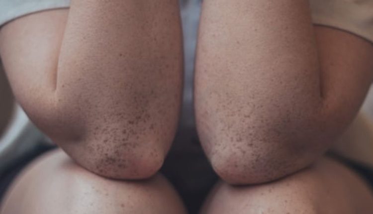 درمان خشکی آرنج و زانو