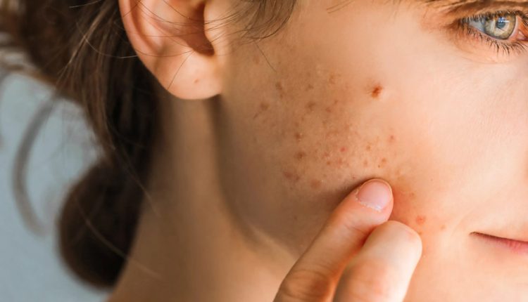 آیا مصرف مرطوب کننده باعث آکنه می‌شود؟