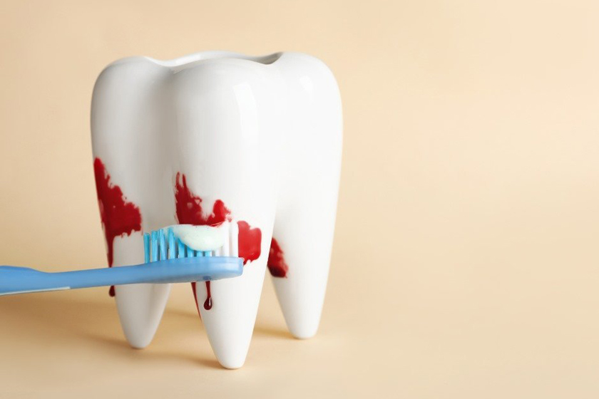 نقش خمیر دندان در پیشگیری از بیماری لثه