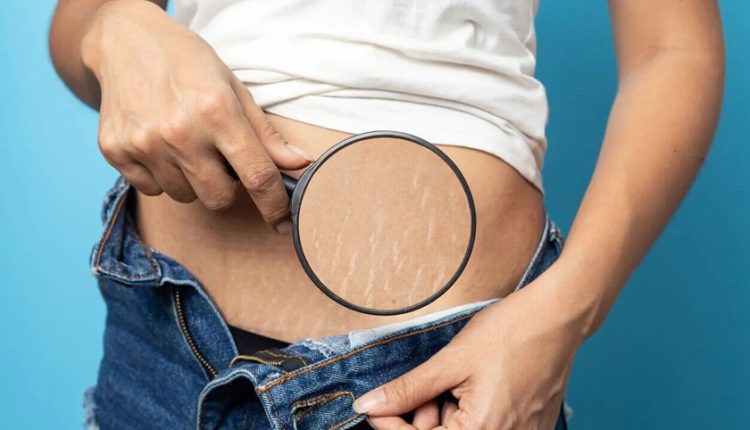 تاثیر لوسیون بدن در درمان ترک‌های پوستی