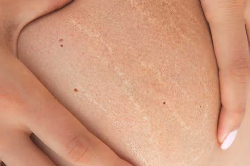 تاثیر لوسیون بدن در درمان ترک‌های پوستی