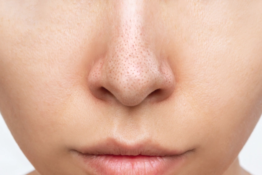 جوش سر سیاه