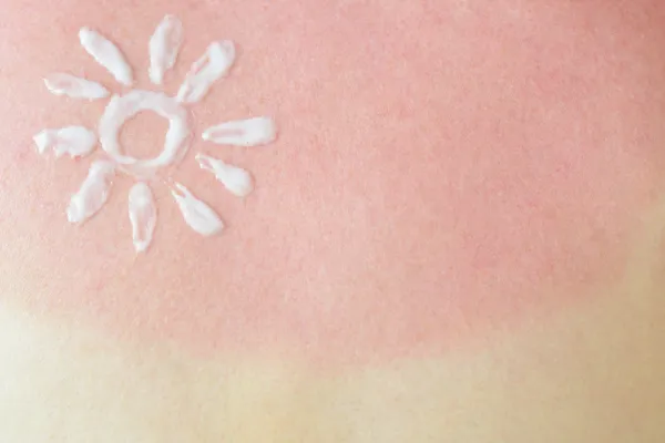 2. آفتابسوختگی