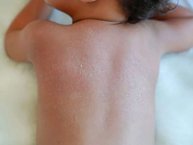 آفتاب سوختگی در کودکان با پوست روشن یا حساس