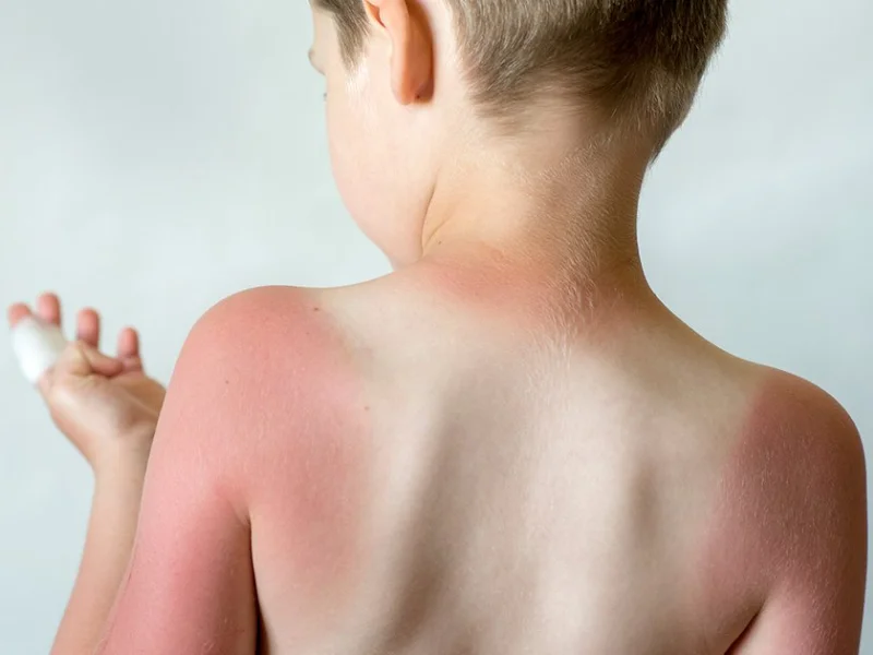 برای آفتاب سوختگی کودکان چه باید کرد؟ روش های درمان