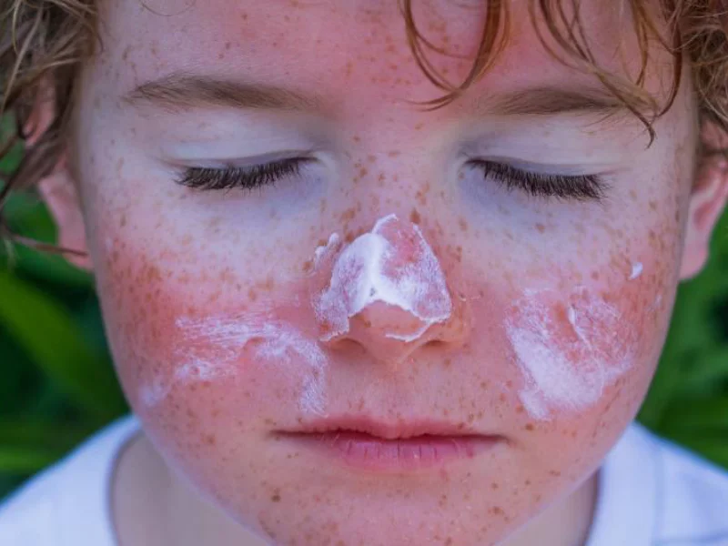 نشانه های آفتاب سوختگی صورت کودک