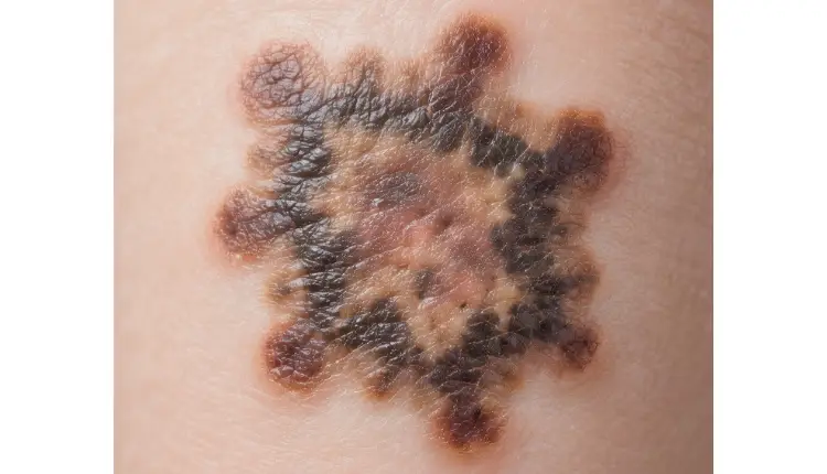 تصویر لکه های پوستی خطرناک | مجله لوکسیرانا