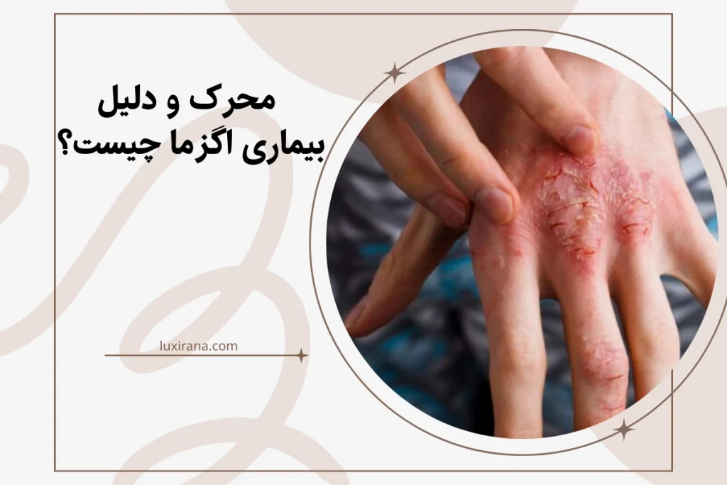 محرک و دلیل بیماری اگزما چیست؟