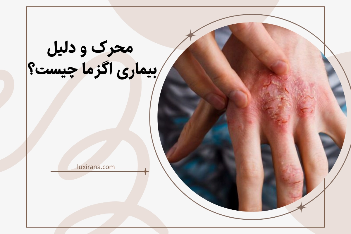 محرک و دلیل بیماری اگزما چیست؟