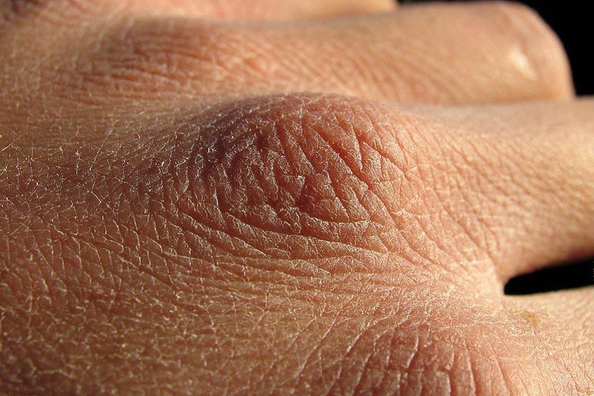 جلوگیری از ترک‌های پوستی