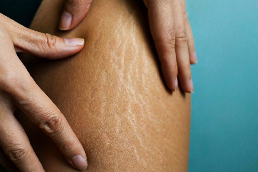 جلوگیری از ترک‌های پوستی