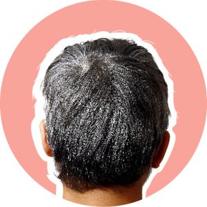 تشخیص موهای آسیب دیده