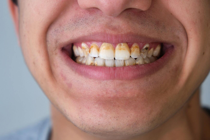 تأثیر مسواک زدن در پیشگیری از تشکیل پلاک و تارتار