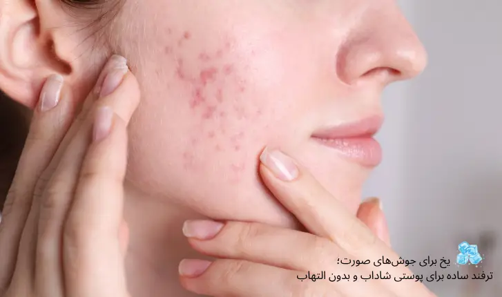 یخ برای جوش های صورت+ترفند ساده و طبیعی برای کاهش جوش و التهاب|مجله لوکسیرانا