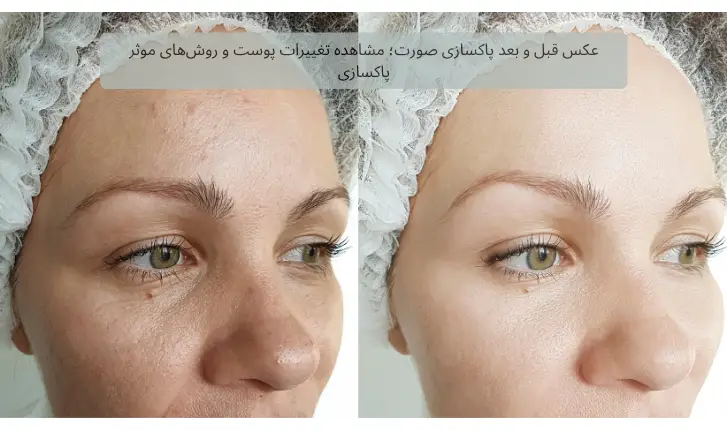عکس قبل و بعد پاکسازی صورت؛ مشاهده تغییرات پوست و روش‌های موثر پاکسازی | مجله لوکسیرانا