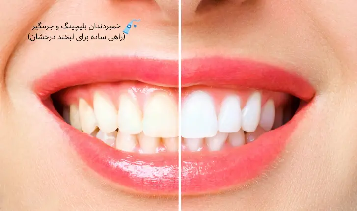 خمیردندان بلیچینگ و جرمگیر (راهی ساده برای لبخند درخشان) | مجله لوکسیرانا