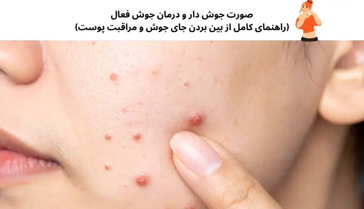 صورت جوش دار و درمان جوش فعال (راهنمای کامل از بین بردن جای جوش و مراقبت پوست) | مجله لوکسیرانا