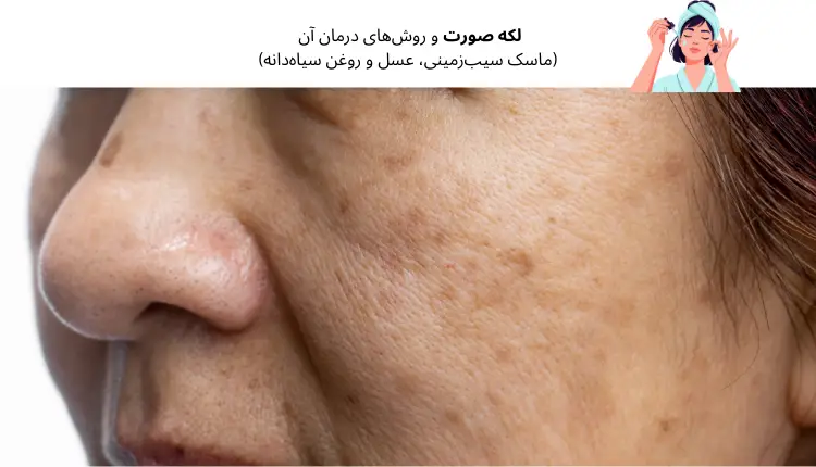 لکه صورت و روش‌های درمان آن (ماسک سیب‌زمینی، عسل و روغن سیاه‌دانه) | مجله لوکسیرانا
