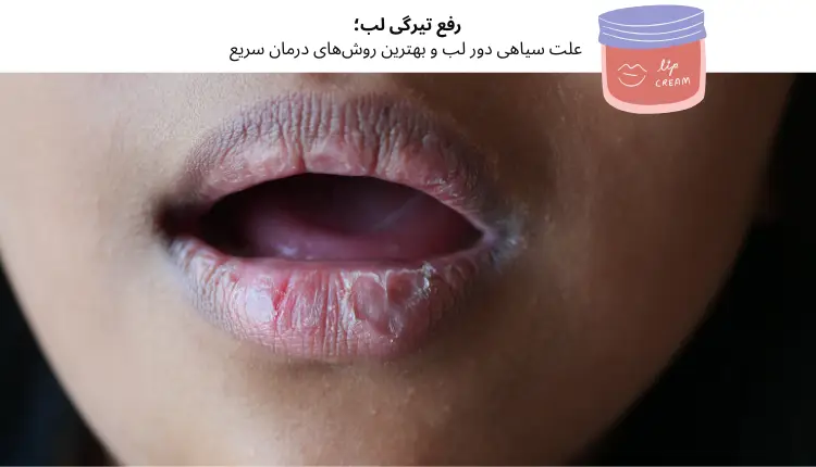 رفع تیرگی لب؛ علت سیاهی دور لب و بهترین روش‌های درمان سریع | مجله لوکسیرانا