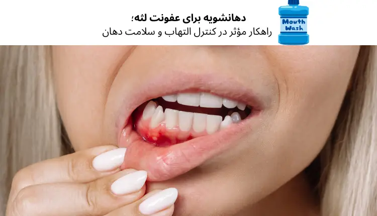 دهانشویه برای عفونت لثه؛ راهکار مؤثر در کنترل التهاب و سلامت دهان | مجله لوکسیرانا